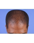 Before Hair Transplant&nbsp;Front